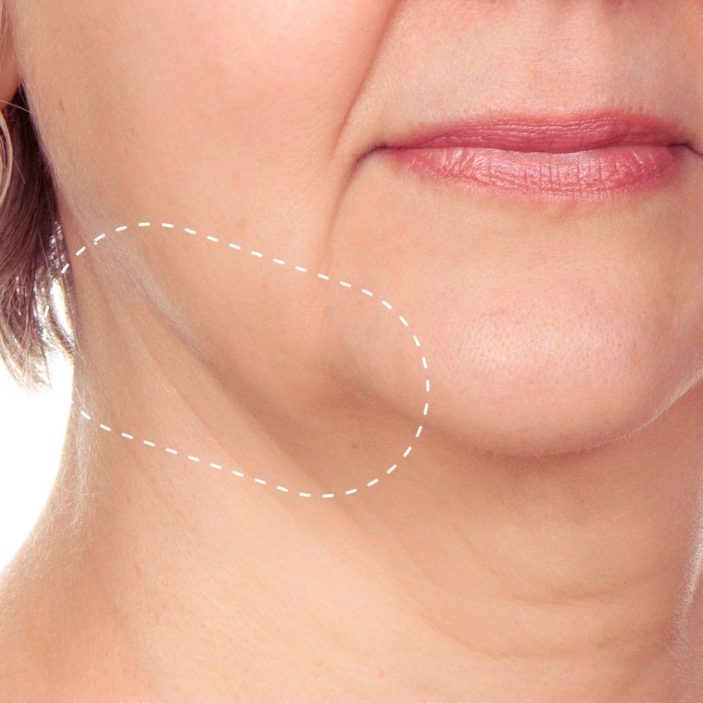 Saggy Skin Condition