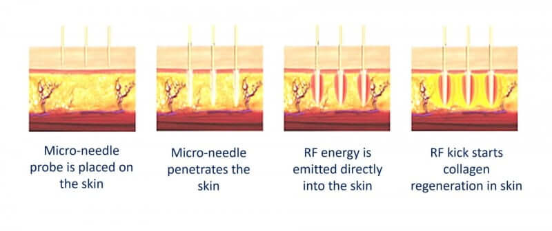 How does Sylfirm X Work