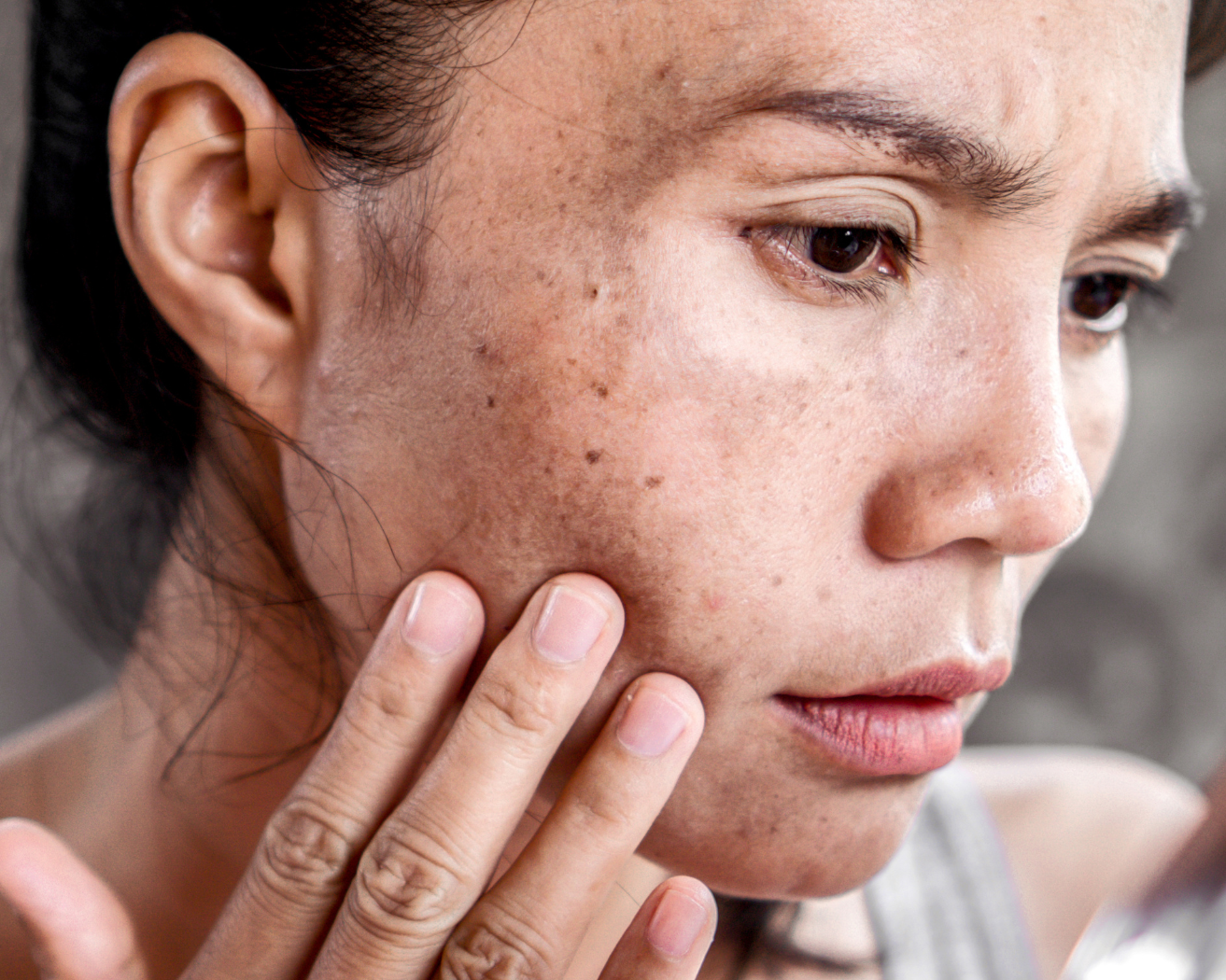 What Skin Conditions Can Pico Laser Treat?
