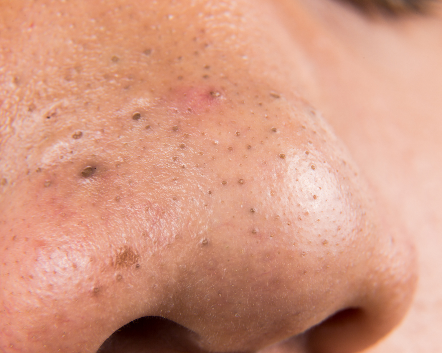 8 Swear By Tips To Get Rid of Blackheads for Good