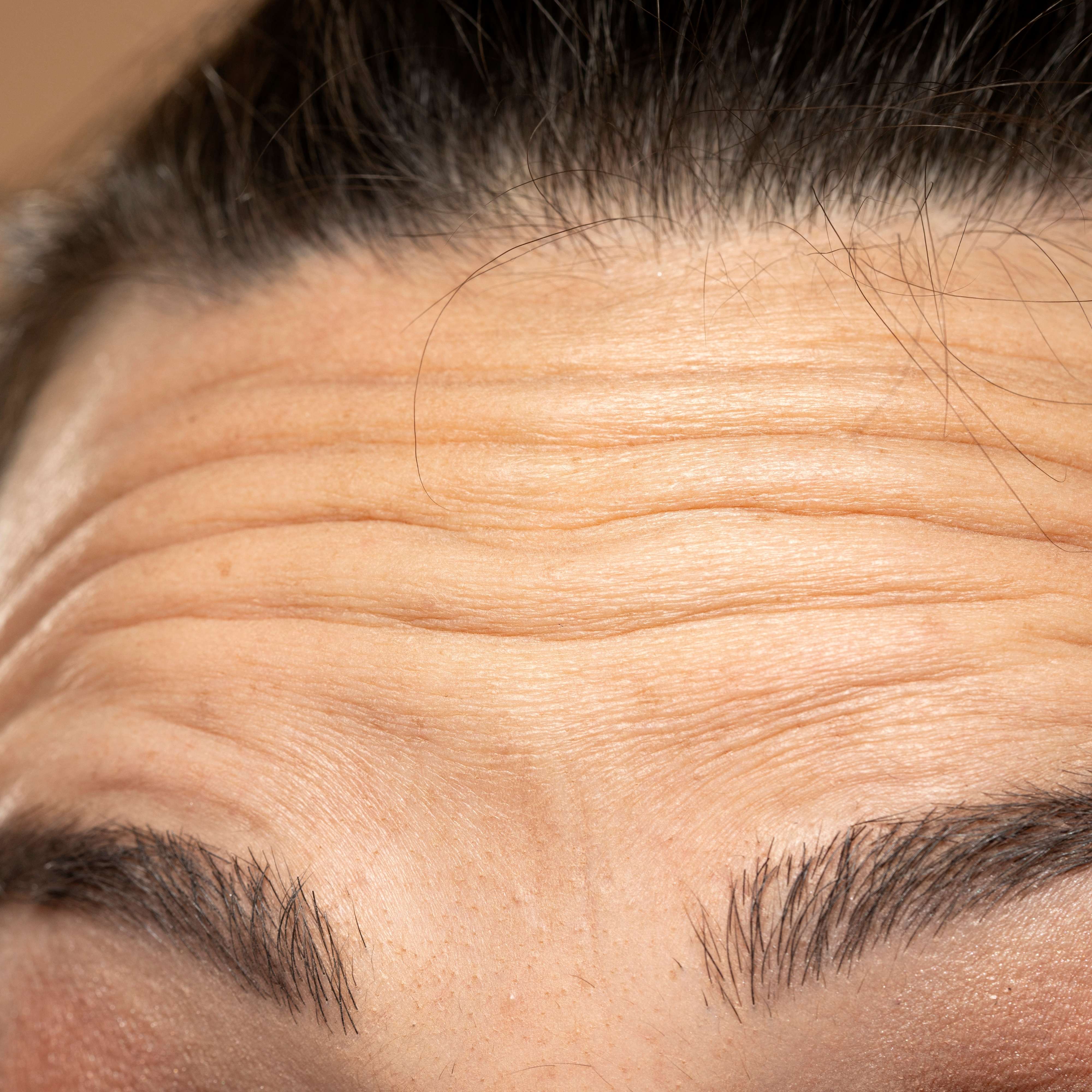 forehead line