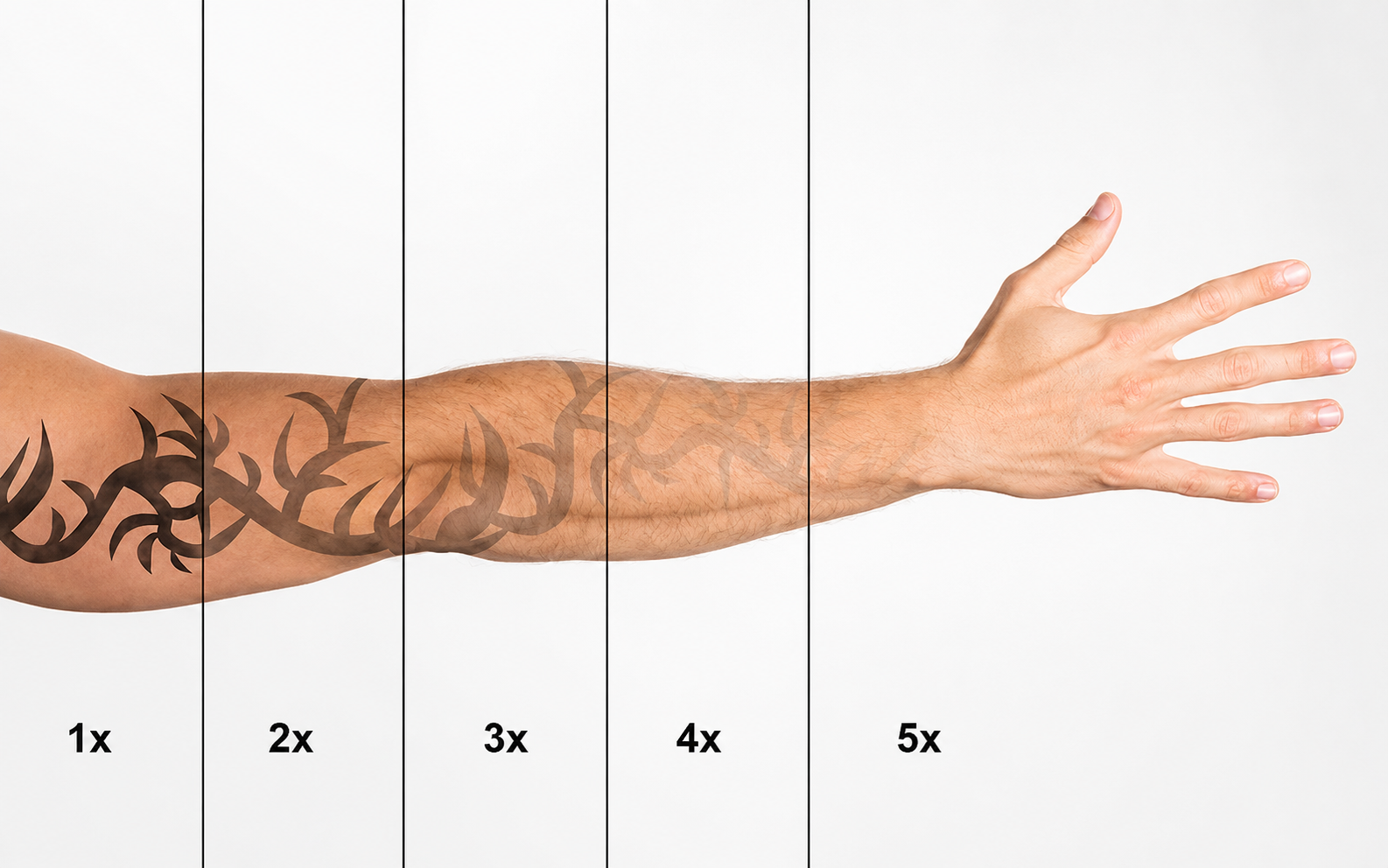 tattoo removal