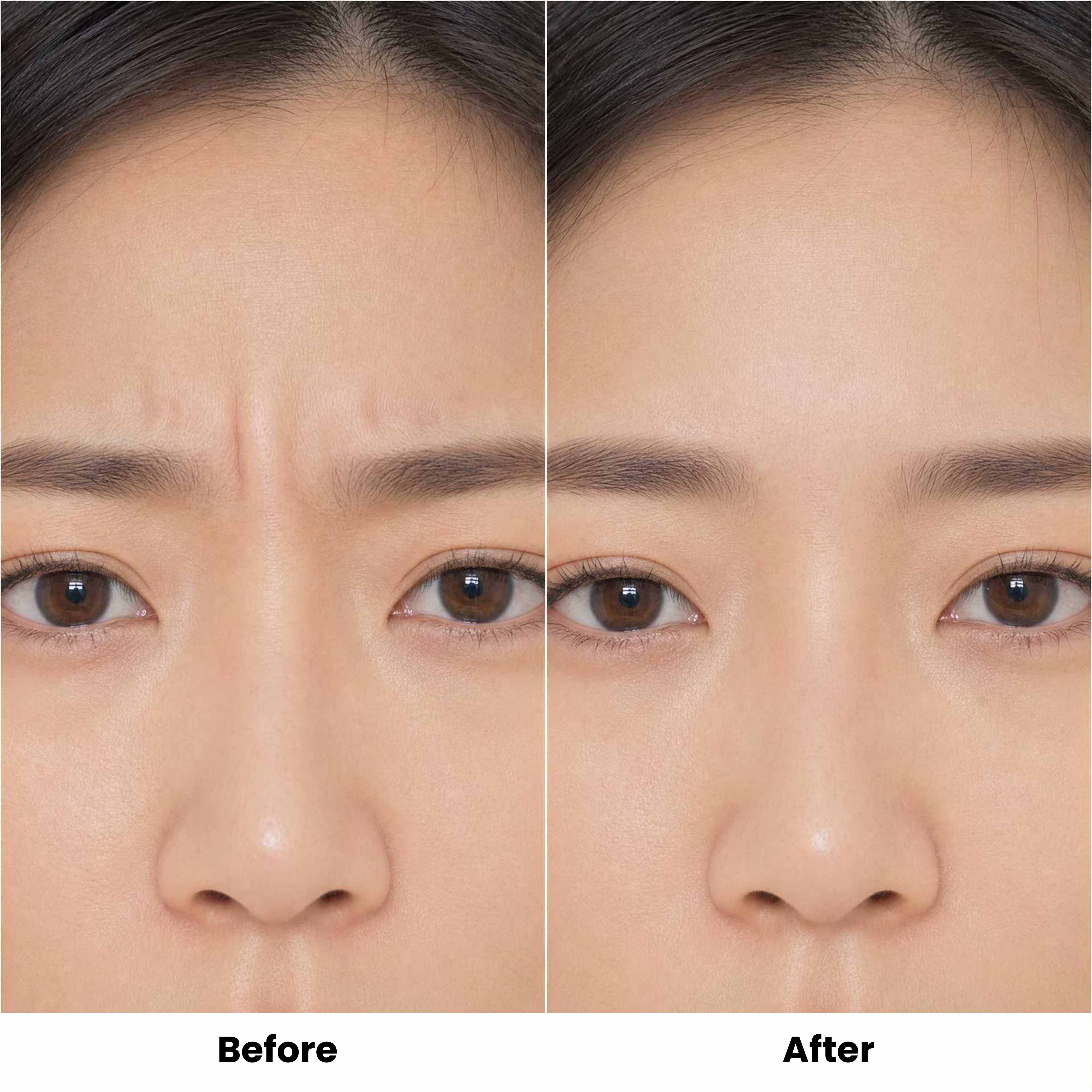 frown line before after