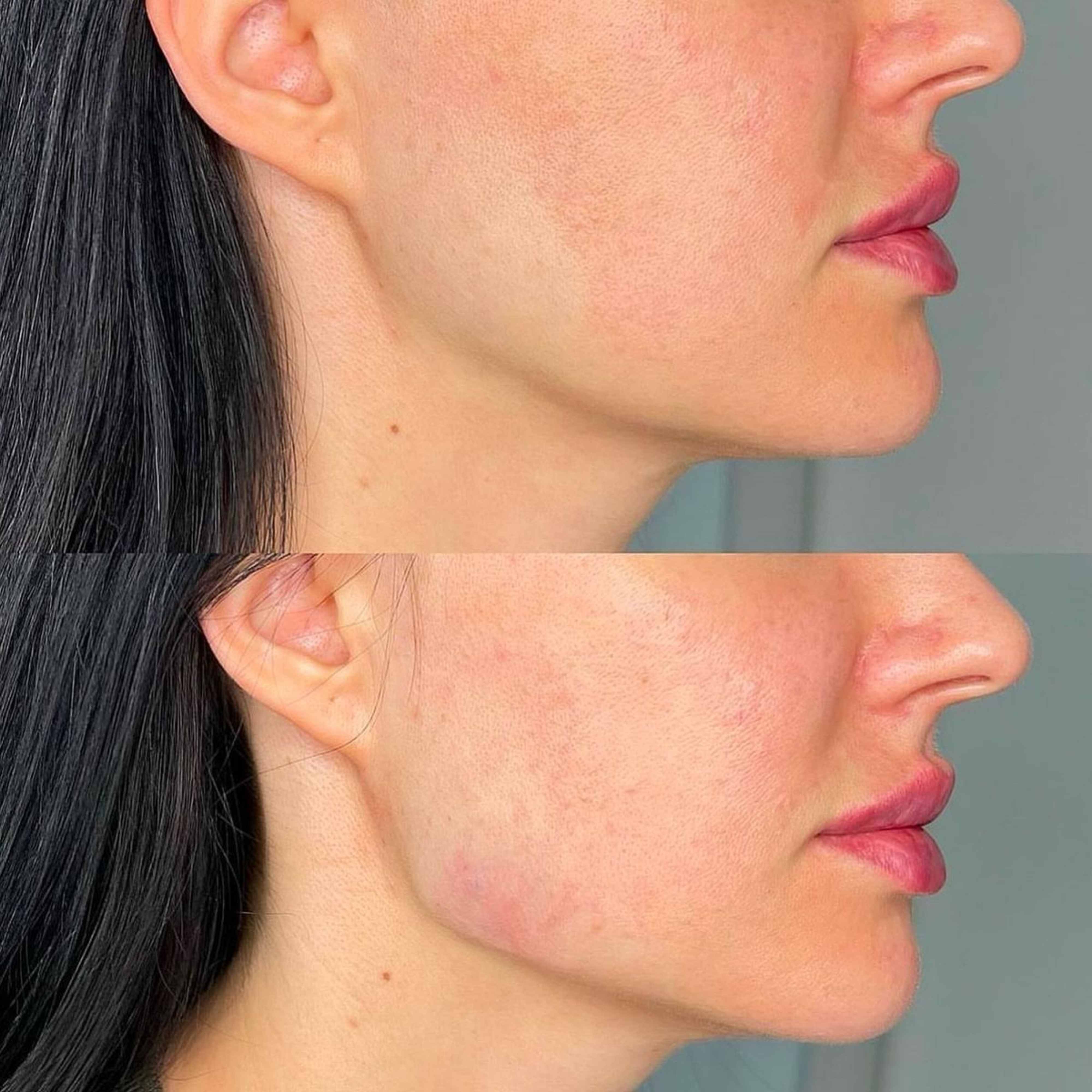 jaw slimming before after