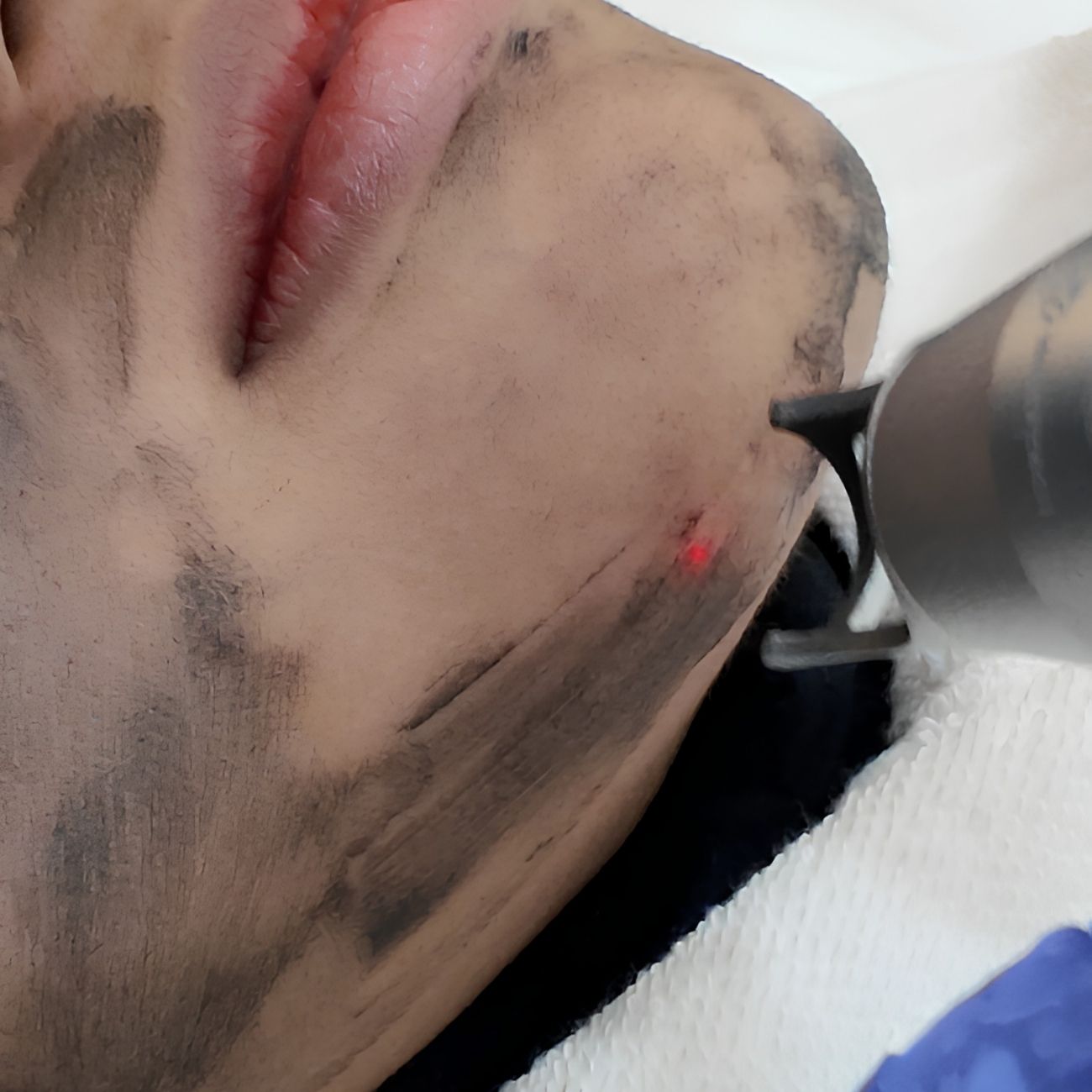 carbon laser