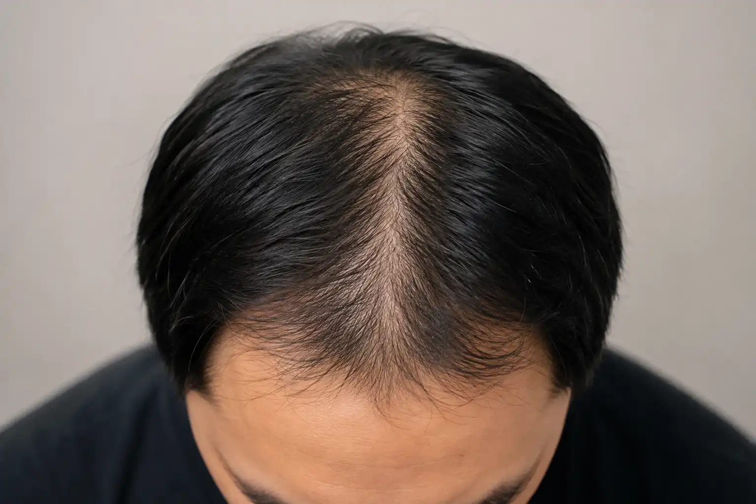bald 1