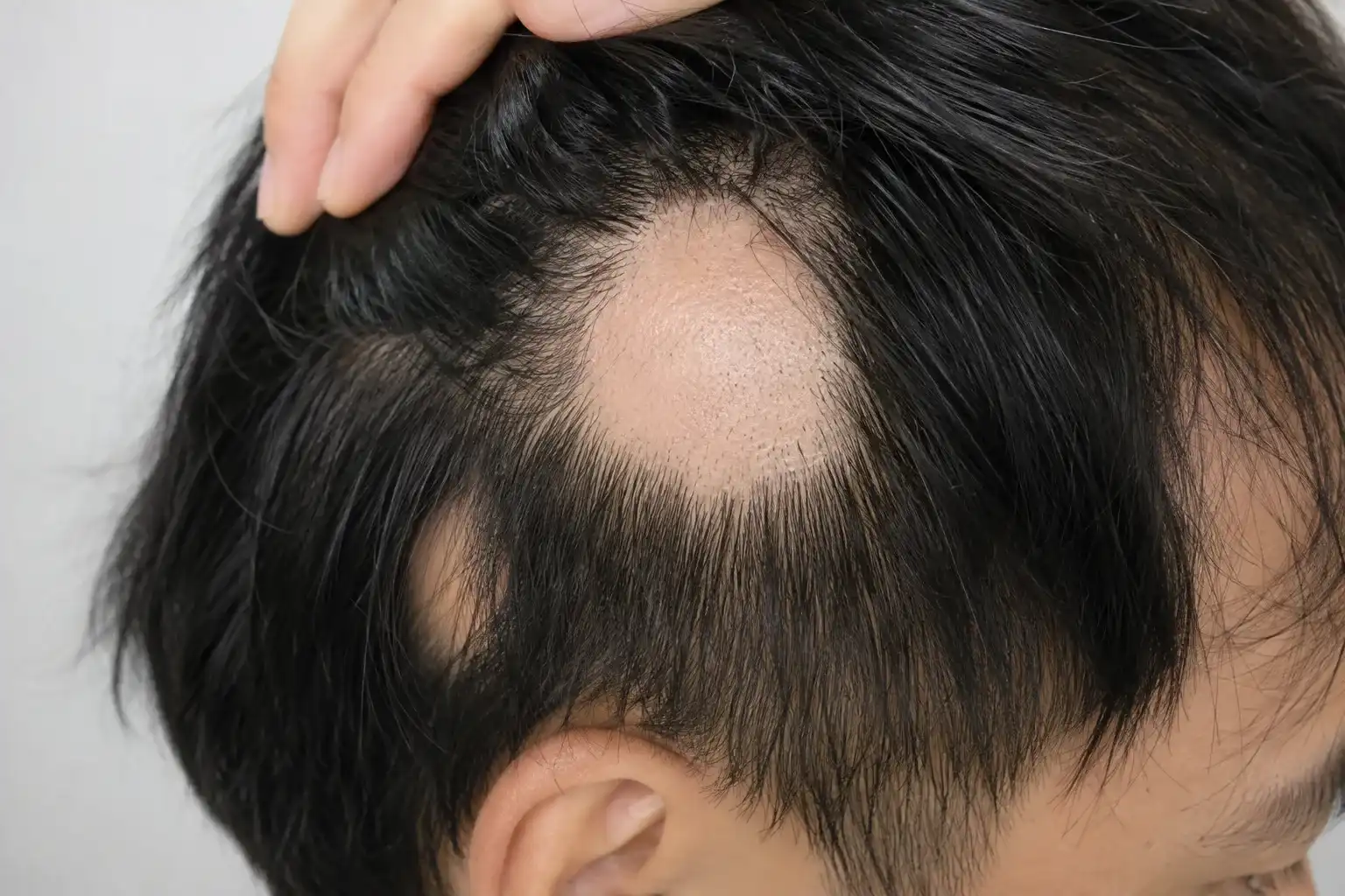 bald 3